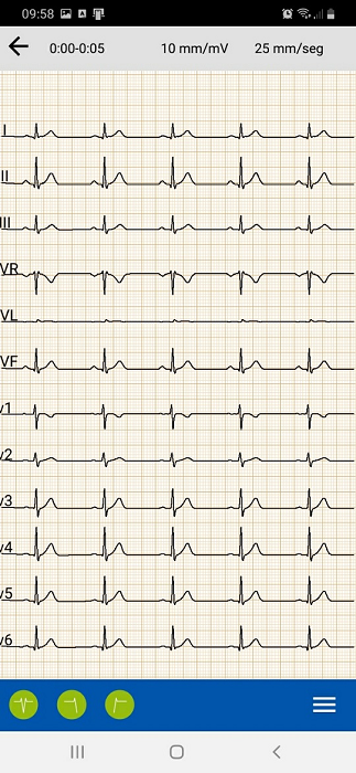 revision ECG